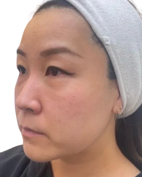Tear Trough, After · Case 5 · Luowei Medical Aesthetics Clinic