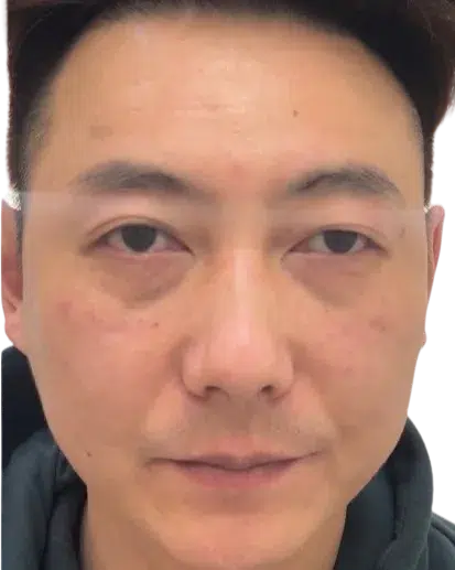 Tear trough · after · Case 12 · Luowei Medical Aesthetics Clinic