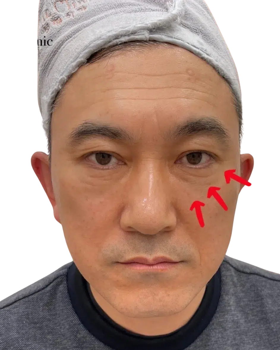 Tear troughs After · Case 24 · Luowei Medical Aesthetics Clinic