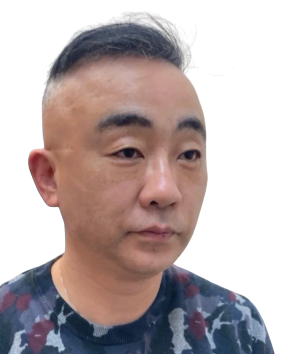 Tear troughs — After · Case 37 · Luowei