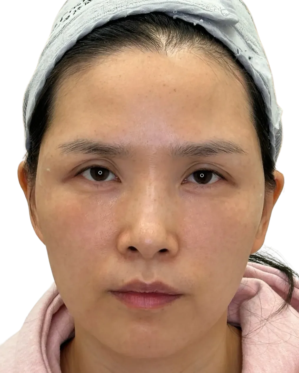 Tear Trough — After · Case 40 · Luowei Medical Aesthetics Clinic