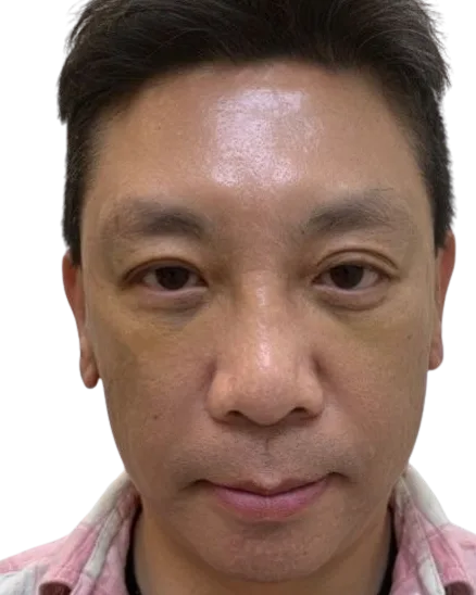 Tear Trough, After · Case 45 · Luowei Medical Aesthetics Clinic