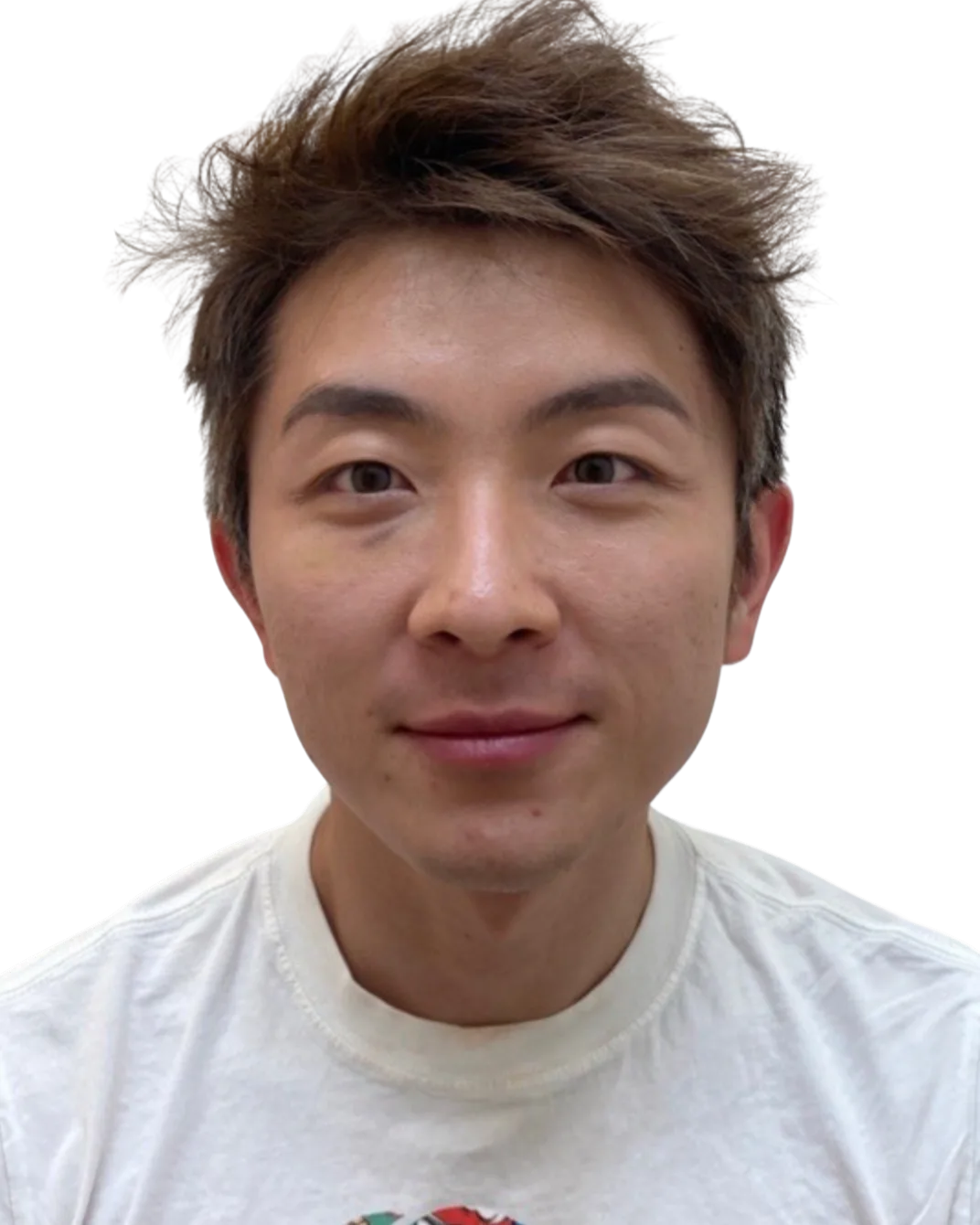 Tear trough · after · Case 48 · Luowei Medical Aesthetics Clinic