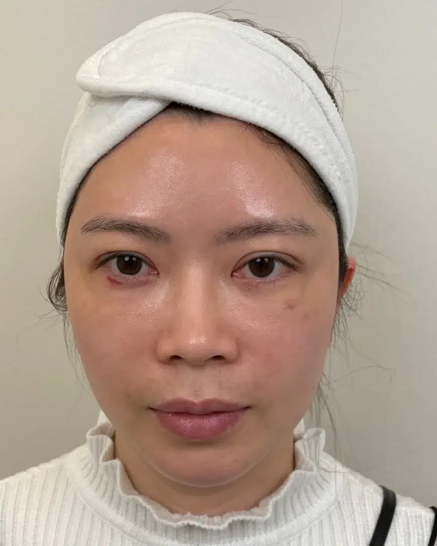Tear troughs After · Case 50 · Luowei Medical Aesthetics Clinic