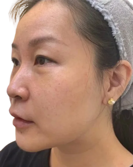Tear troughs Before · Case 5 · Luowei Medical Aesthetics Clinic