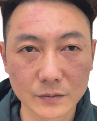 Tear troughs — Before · Case 12 · Luowei