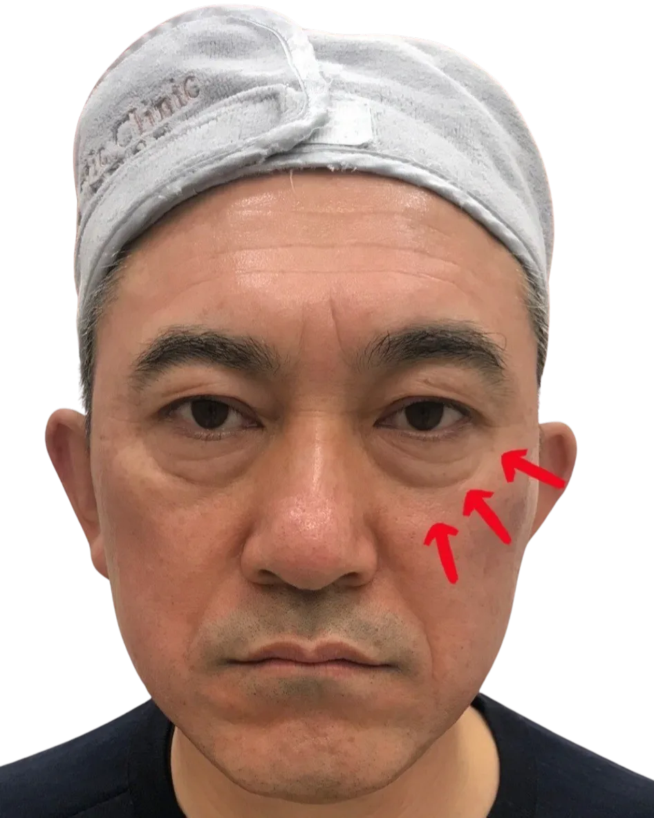 Tear Trough — Before · Case 24 · Luowei Medical Aesthetics Clinic