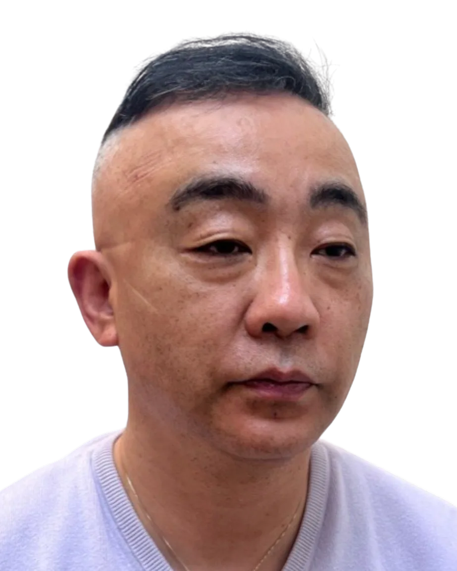 Tear Trough, Before · Case 37 · Luowei Medical Aesthetics Clinic