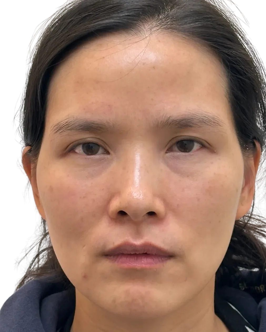 Tear trough · before · Case 40 · Luowei Medical Aesthetics Clinic