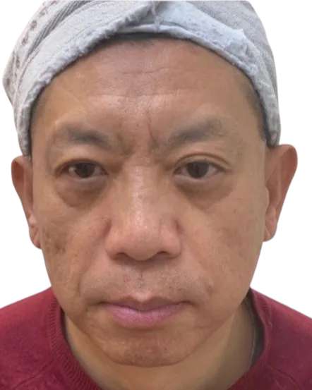 Tear troughs Before · Case 45 · Luowei Medical Aesthetics Clinic