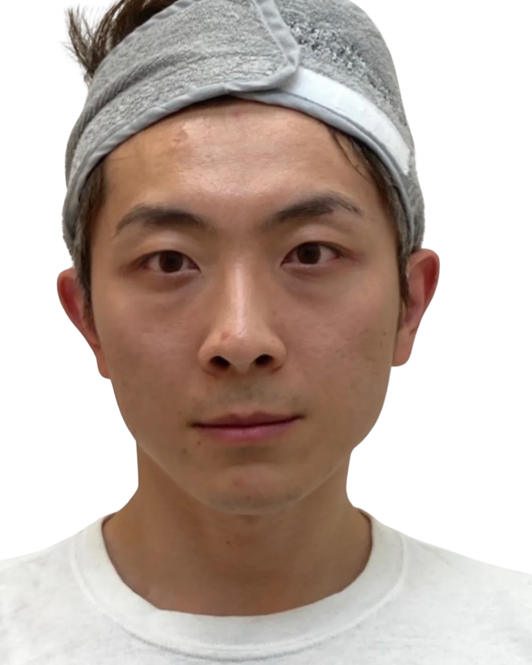 Tear troughs — Before · Case 48 · Luowei