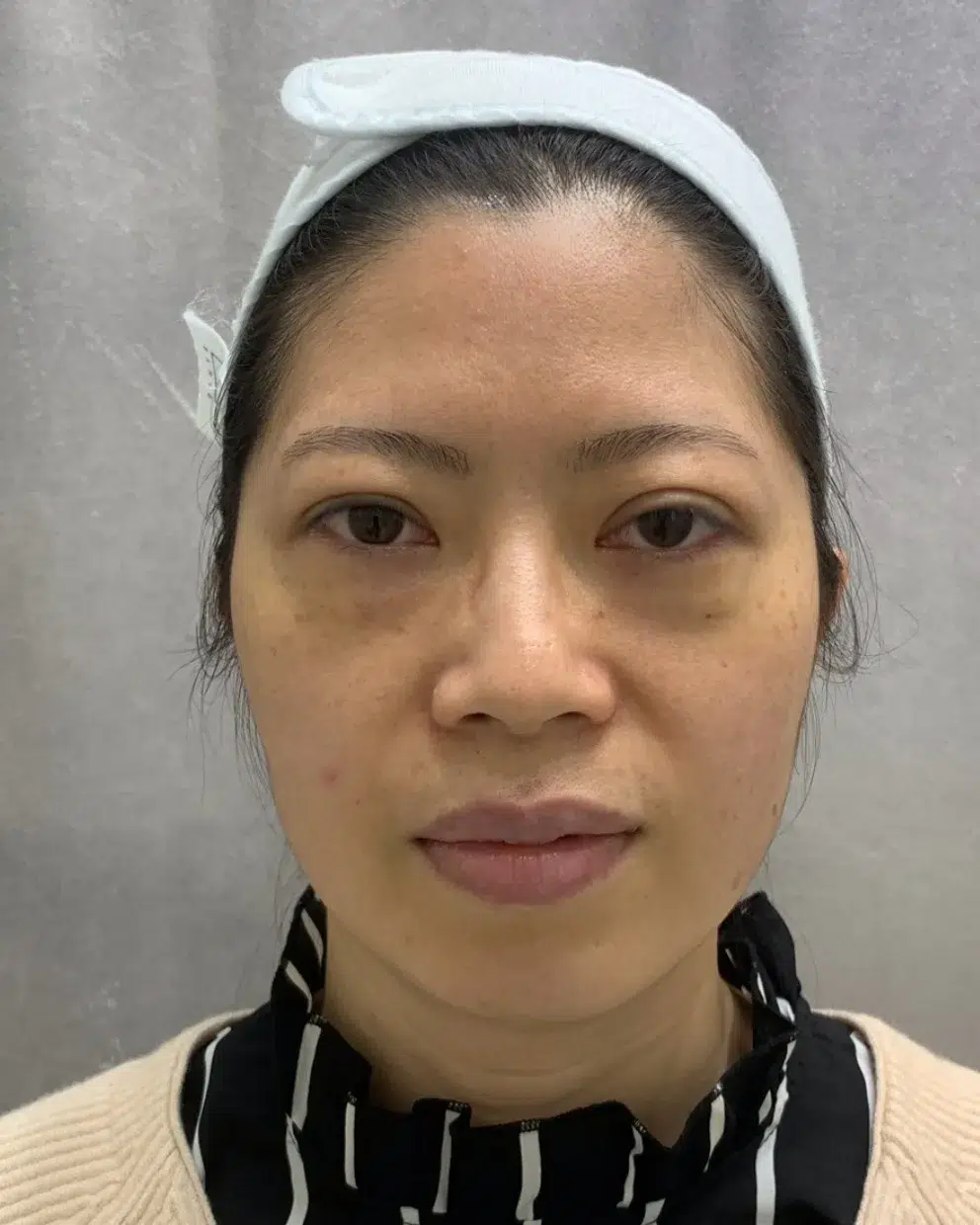 Tear Trough — Before · Case 50 · Luowei Medical Aesthetics Clinic