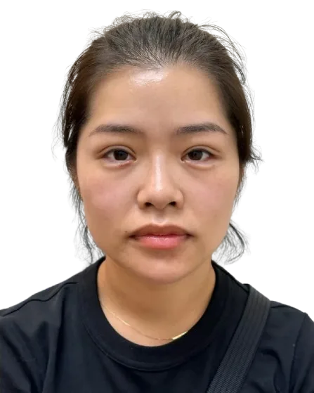 thread-double-eyelid After · Case 39 · Luowei
