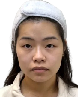 thread-double-eyelid Before · Case 39 · Luowei Medical Aesthetics Clinic