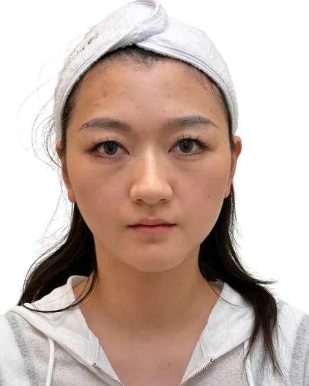 thread-double-eyelid Before · Case 42 · Luowei Medical Aesthetics Clinic