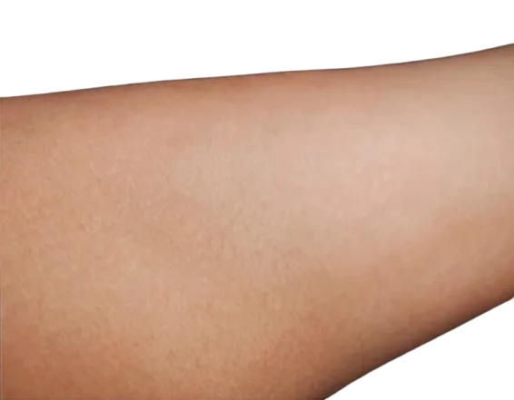 Laser Hair Removal — Unwanted Hair Before & After · Multi-Device Protocol · Luowei Medical Aesthetics Clinic Nanjing · Case 01
