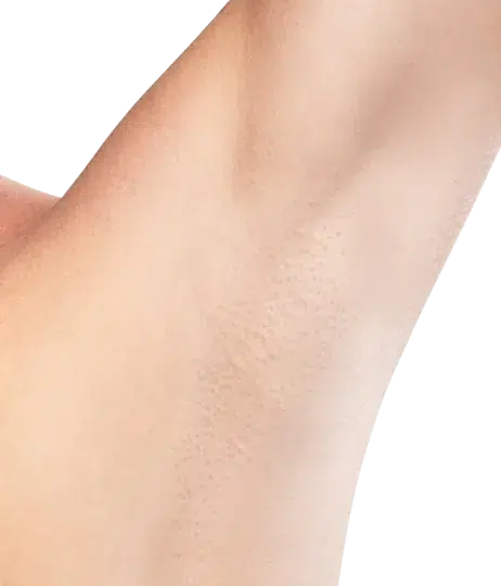 Before & After — Laser Hair Removal on Deeper Skin Tones · Nd:YAG Deep-Penetration Protocol · Luowei Medical Aesthetics Clinic Nanjing · Case 03