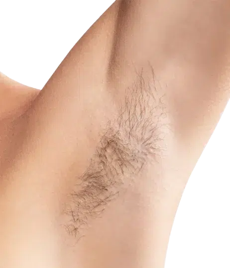 Laser Hair Removal — Before & After, Deeper Skin Tone · Nd:YAG Deep-Penetration Protocol · Luowei Medical Aesthetics Clinic, Nanjing · Case 03
