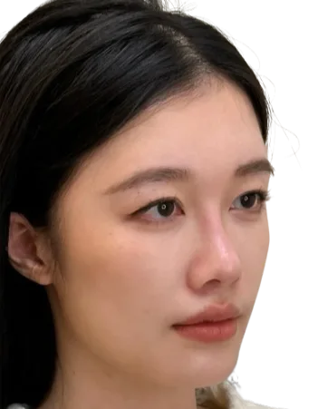 Midface Volume Loss & Flat Apple Cheeks — After · Case 05 · Luowei Medical Aesthetics Clinic