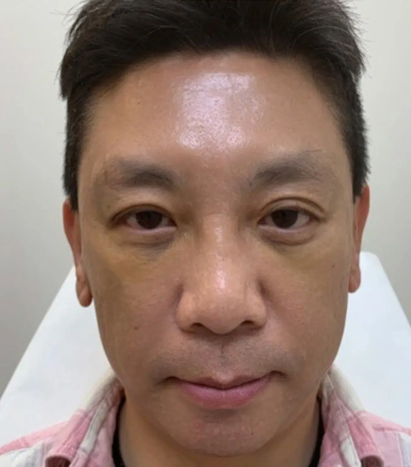 Melasma After Treatment · Case 06 · Luowei Medical Aesthetics Clinic