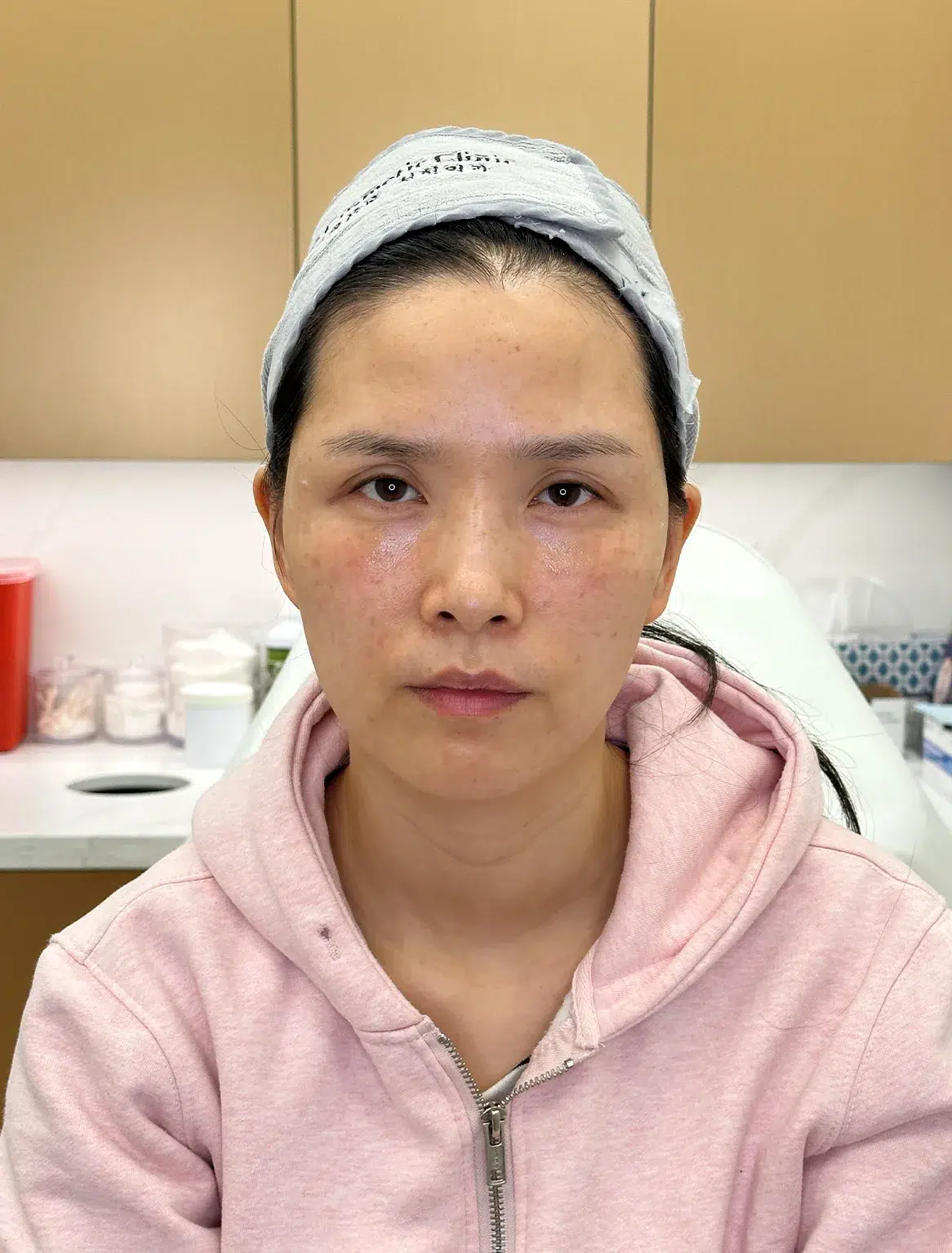 Volume Loss — After · Case 26 · Luowei Medical Aesthetics Clinic