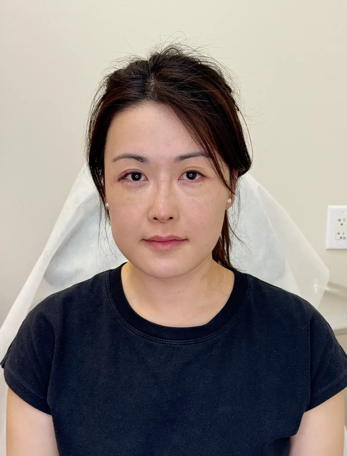 Volume Loss, After · Case 31 · Luowei Medical Aesthetics Clinic