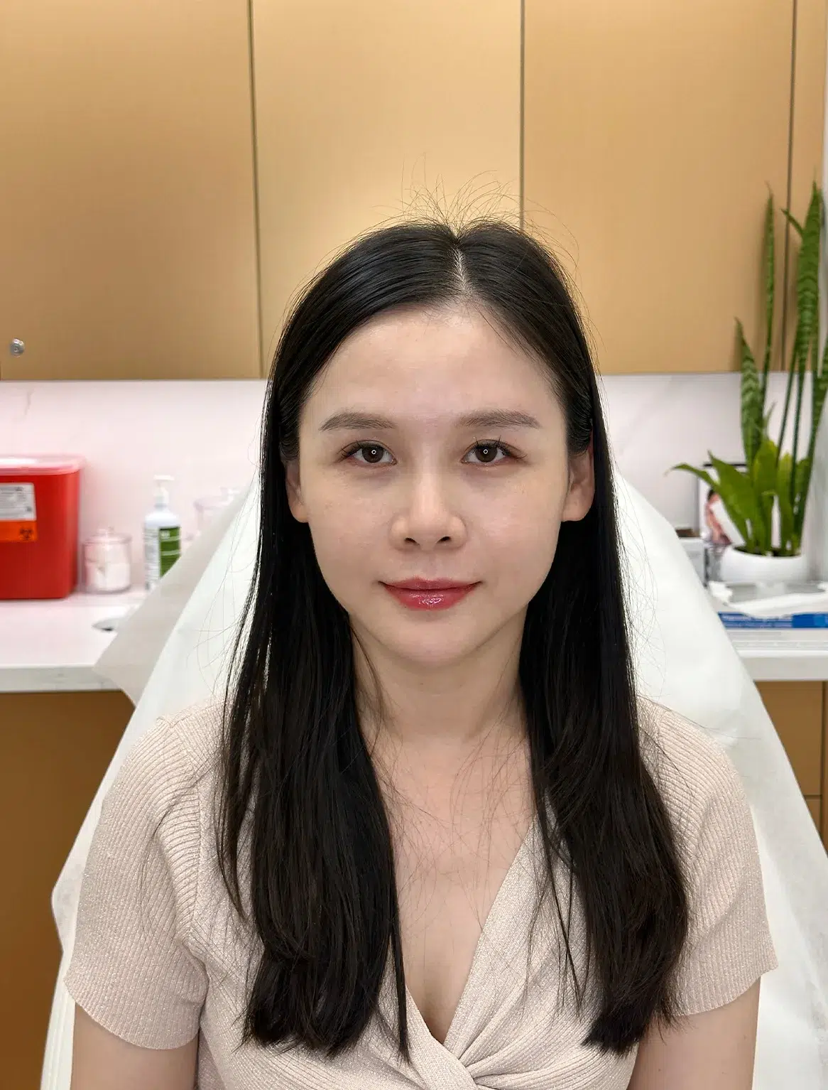 Volume loss · after · Case 34 · Luowei Medical Aesthetics Clinic