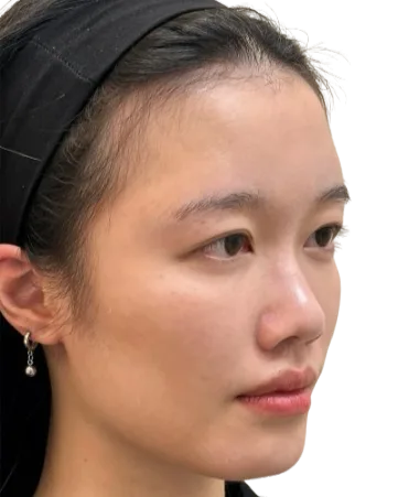 Midface Volume Loss & Flat Apple Cheeks — Before · Case 05 · Luowei Medical Aesthetics Clinic