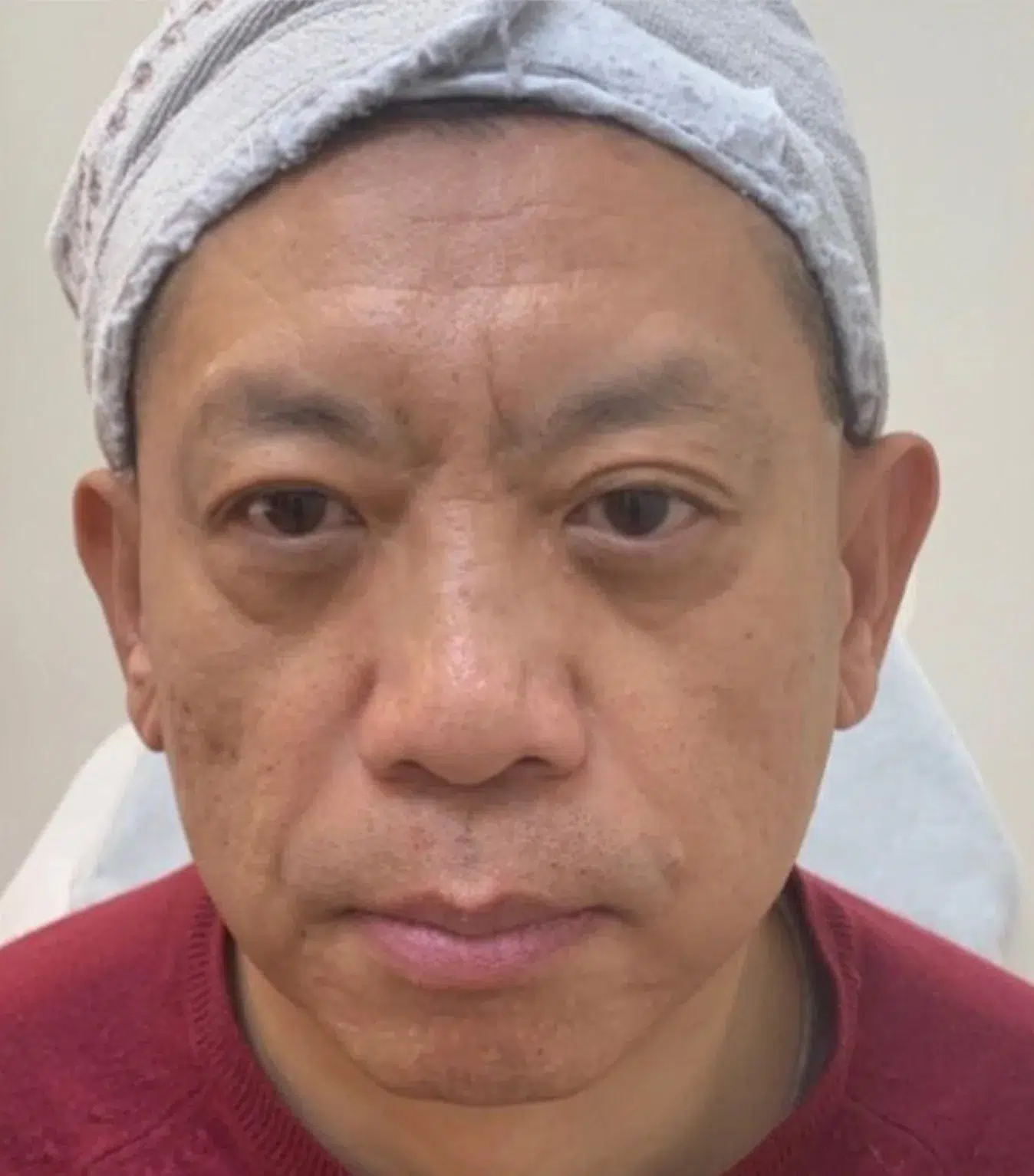 Melasma Before Treatment · Case 06 · Luowei Medical Aesthetics Clinic