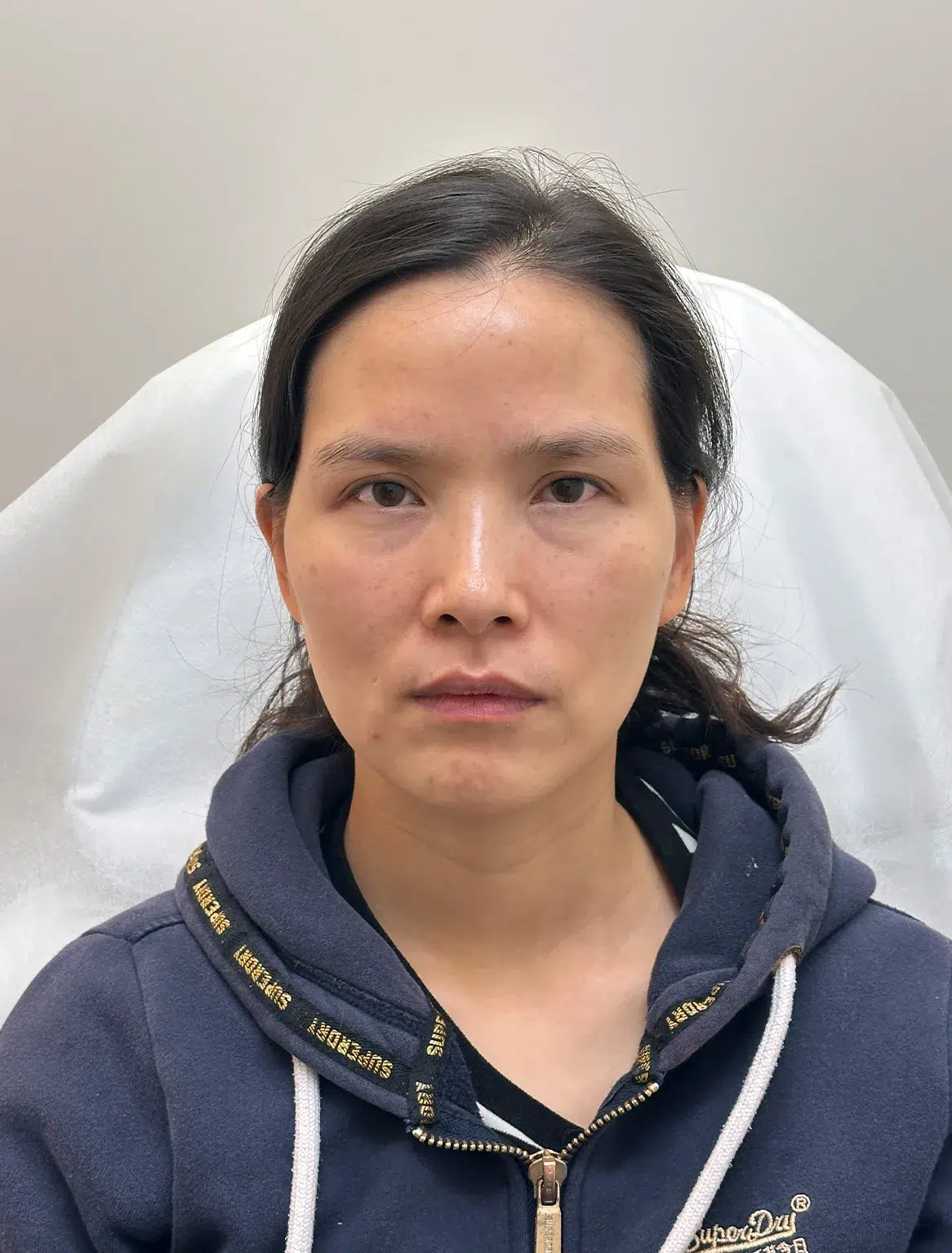 Volume loss · before · Case 26 · Luowei Medical Aesthetics Clinic