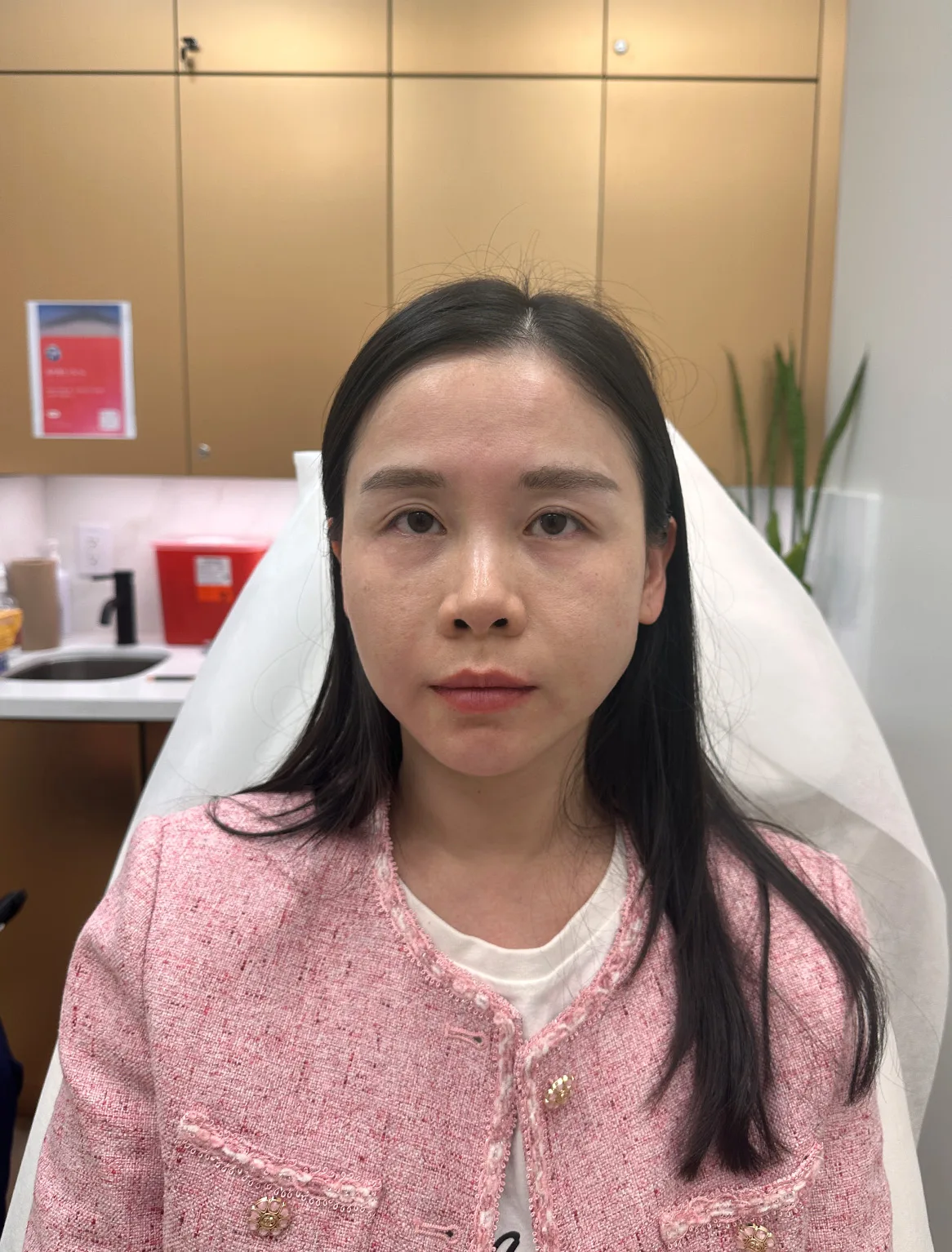 Volume loss — Before · Case 34 · Luowei