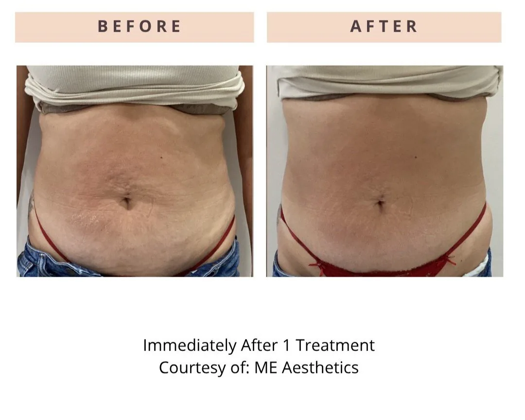 ONDA PRO — CoolWaves abdomen before and after, clinical case