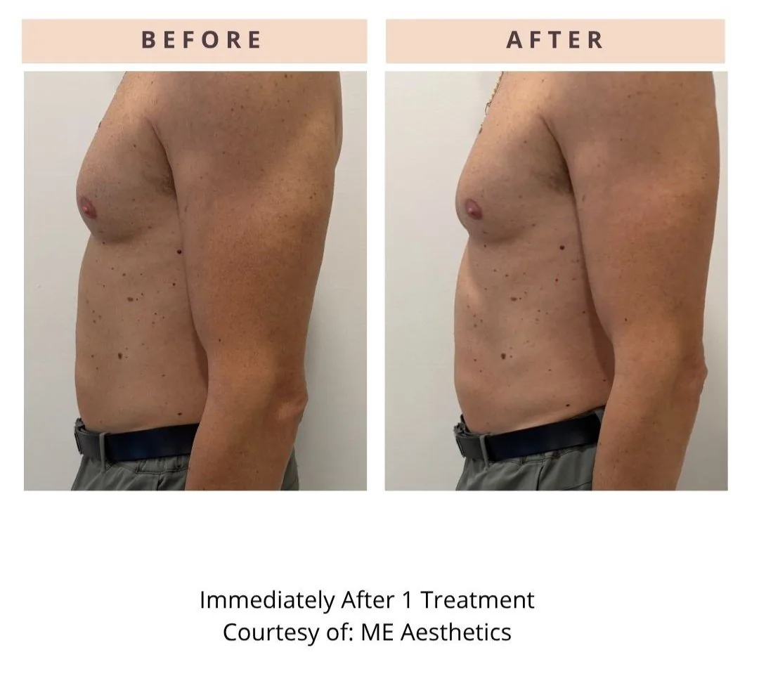 ONDA PRO — CoolWaves male abdomen before and after, clinical case