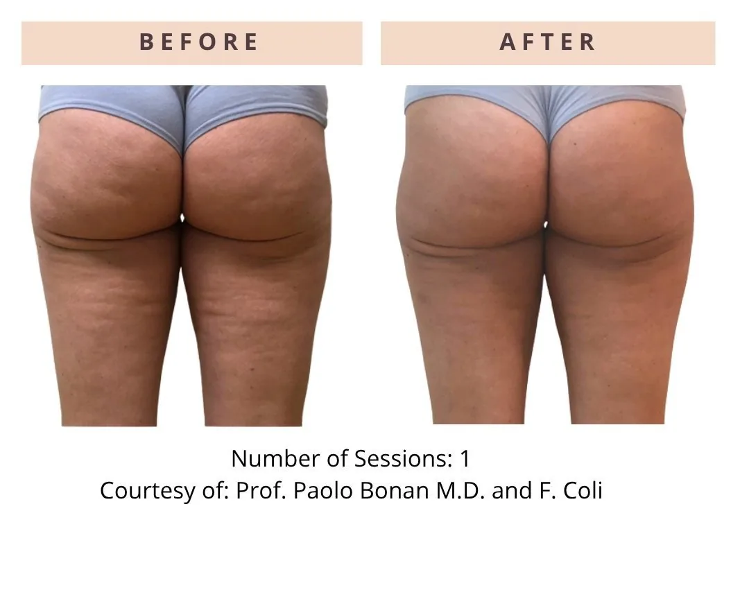 ONDA PRO — CoolWaves cellulite before and after, clinical case