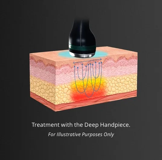ONDA PRO — CoolWaves microwave treatment with the Deep Handpiece, Luowei Medical Aesthetics Clinic Nanjing