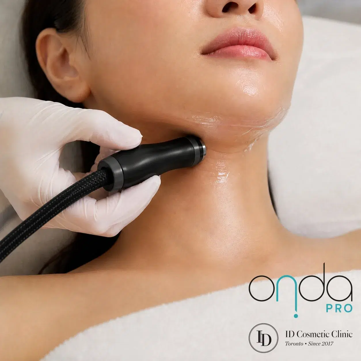 ONDA PRO — CoolWaves handpiece treatment on the jawline and under-chin, Luowei Medical Aesthetics Clinic Nanjing